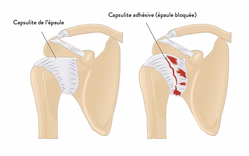 capsulite epaule