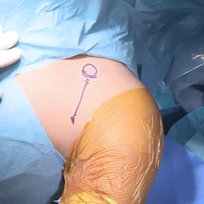arthroscopie epaule